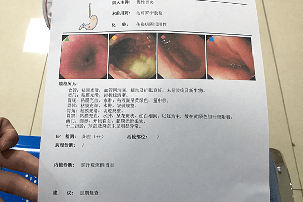 感染HP幽门螺杆菌阴性+，食物疗法效果好，不伤胃更安全！