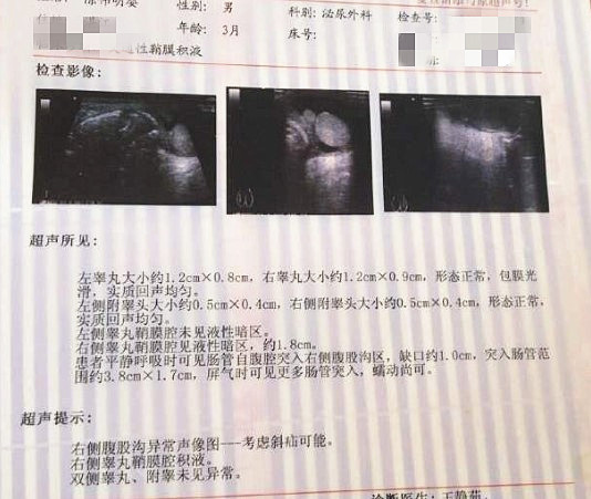 鞘膜积液报告单