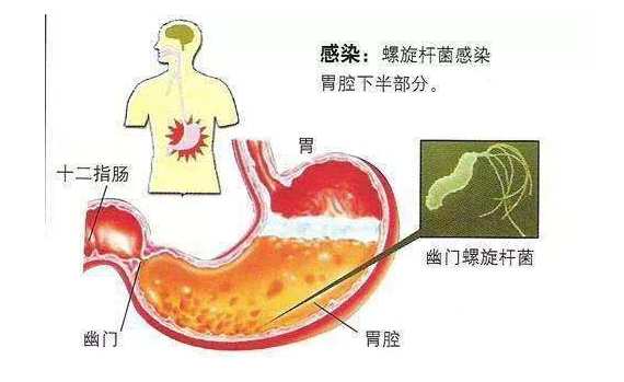 长期口臭是胃癌的前兆