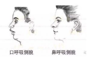 扁桃体肥大的最佳睡姿，下面内容你知道吗？