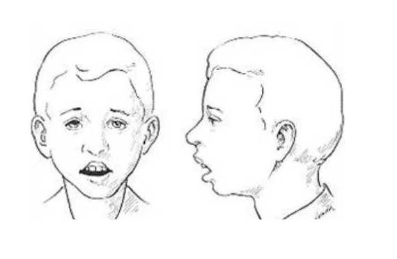 4岁娃腺样体大面容照片