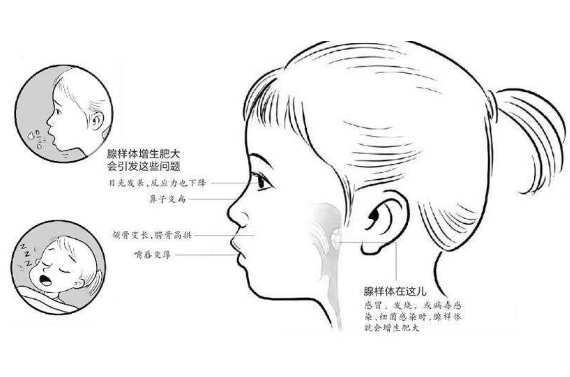 儿童腺样体肥大图片