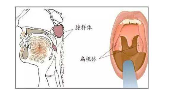 腺样体面容图片