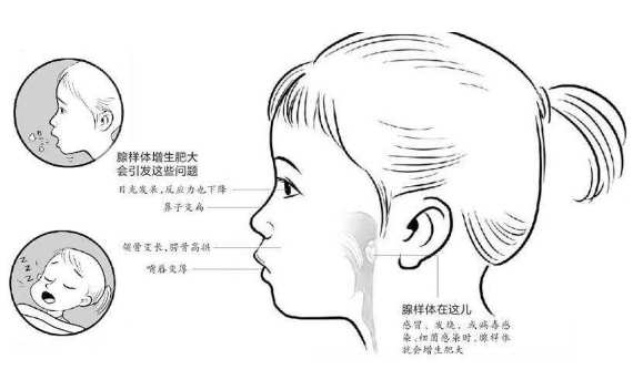 4岁娃腺样体大面容照片