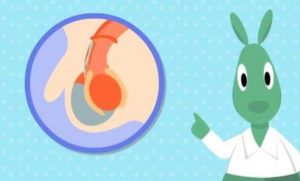 新生儿鞘膜积液是什么原因造成的