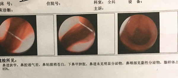 宁药尘鼻康外用套装，轻松护理儿童扁腺体肥大！