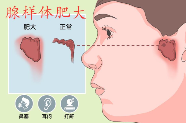 芬多萜治疗腺样体肥大怎么样，效果是真是假？