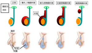 关于鞘膜积液开刀与微创的选择！